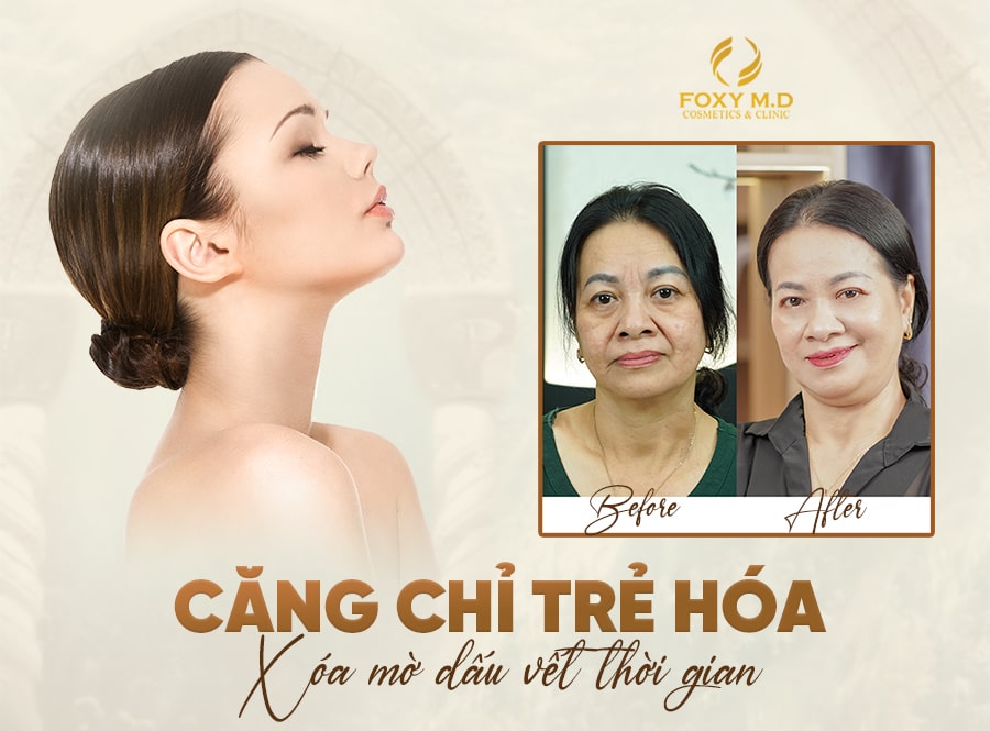 Căng Chỉ Full Face: Bí Quyết Nâng Cơ Trẻ Hóa Làn Da Không Cần Phẫu Thuật